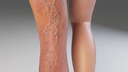 Varicose veins treatment