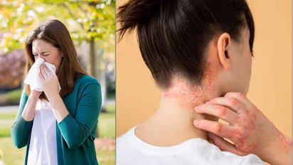 World Allergy day 2025: অ্যালার্জি থেকে হতে পারে জীবন সংশয়? সামনে এল মারাত্মক তথ্য