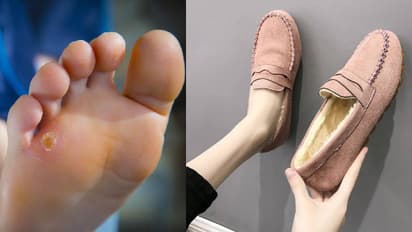 How to wear shoes to avoid foot corns