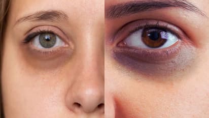 dark circles causes