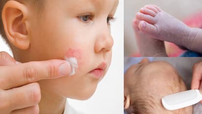 winter baby skin care