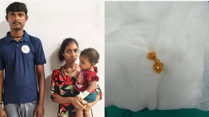 Surat Infant Swallows Gold Earring, Doctors Remove It in 45 Minutes