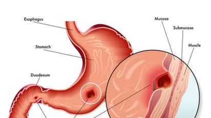 இதோ உங்களுக்காக அல்சரை விரைவில் குணமாக்கும் சில அட்டகாசமான டிப்ஸ்...