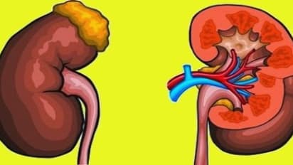 சிறுநீரகத்தை பாதிக்கும் 'நெப்ராடிக் சிண்ட்ரோம்'