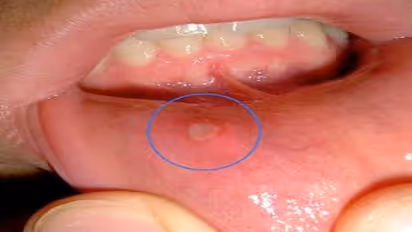 வாய்ப் புண்ணால் அவதியா? இதோவாய்ப்புண்ணை போக்க சில எளிய வழிகள்…