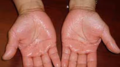 உங்கள் கை, கால்களில் அதிகமாக வியர்க்கிறதா? அதுகூட ஆபத்தான வியாதிதான்... இதை வாசிங்க தெரியும்...