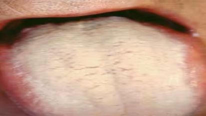 நாக்கின் மீது இருக்கும் வெள்ளைப் படலத்தை போக்க சில வழிகள்…