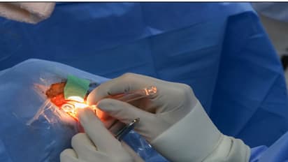 ವಿಶ್ವದ ಮೊದಲ ರೋಬಾಟ್ ಕಣ್ಣಿನ ಶಸ್ತ್ರಚಿಕಿತ್ಸೆ ಯಶಸ್ವಿ