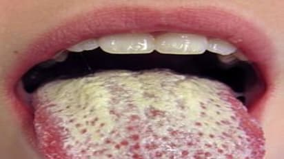 நாக்கில் வெள்ளை படிதல் இருந்தால் உங்கள் உடல் நிலைமை அவ்வளவு மோசம் என்று அர்த்தம்...