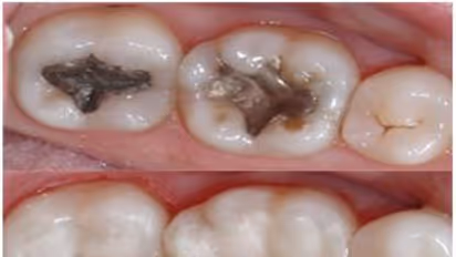 முட்டை ஓட்டைக் கொண்டு சொத்தைப் பற்களை போக்கலாம். எப்படி?