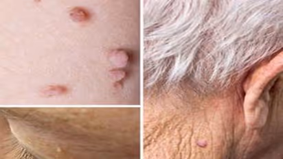 உடலில் எந்தப் பகுதியில் மரு இருந்தாலும் இந்த மருத்துவ முறையை பயன்படுத்தி போக்கலாம்...