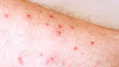 உடலில் சிவப்பு நிற புள்ளிகள் ஏற்பட இதுதான் காரணம்? தெரிஞ்சுக்குங்க உதவும்...