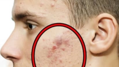 முக அழகை கெடுக்கும் சீழ் நிறைந்த பருக்களை போக்க இத்தனை வழிகள் இருக்கு... ஆண்களுக்கும் உதவும்...