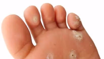 இனி காலில் ஆணியை வெட்டி எடுக்க வேண்டாம். இதோ ஐந்து சூப்பரான இயற்கை வழிகள்...