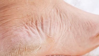 ஆண், பெண் என பாரபட்சம் பார்க்காமல் தாக்கும் பிரச்சனைகளில் இதுவும் ஒன்று; அதற்கு தீர்வும் உண்டு..