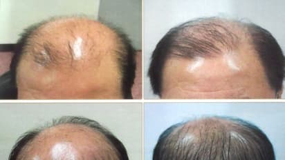 முழுவதுமாக கொட்டிவிட்ட பிறகும் தலைமுடி தாராளமாய் வளர இதோ சில சூப்பர் டிப்ஸ்...