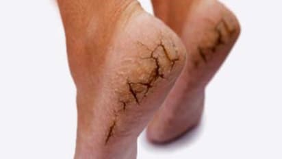 இந்த ஆறு காரணங்களால் தான் நமக்கு குதிகால் வெடிப்பு ஏற்படுகிறது…