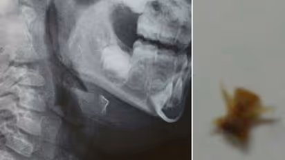 Doctors remove fish bone from respiratory tract of Kerala toddler