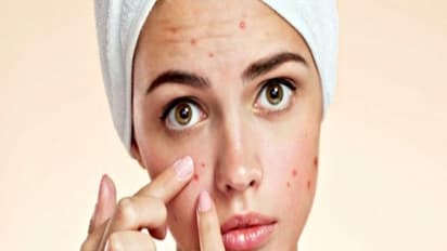 எண்ணெய் சருமத்தில் முகப்பருக்கள் வந்தால் பயப்பட வேண்டாம்? சூப்பர் டிப்ஸ் உள்ளே...