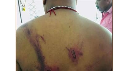 കസ്റ്റഡിയിലെടുത്ത ഡിവൈഎഫ്ഐ പ്രവര്‍ത്തകനെ പൊലീസ് ഹോക്കി സ്റ്റിക്ക് കൊണ്ട് മര്‍ദ്ദിച്ചെന്ന് പരാതി