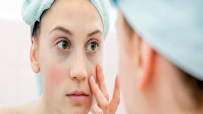 எளிதில் தழும்புகளைப் போக்க வீட்டிலேயே இருக்கும் சிறப்பான வைத்திய முறை; பக்க விளைவு இல்லாதது...