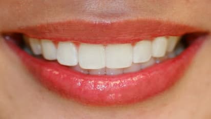 பல்லு இருக்கிறவன் பக்கோடா சாப்பிடுறான் பழமொழியா...? மருத்துவ மொழியா...?