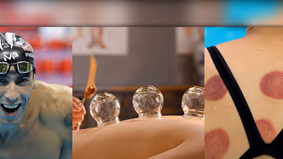 Ancient blood sucking therapy triggers angry debate on Facebook