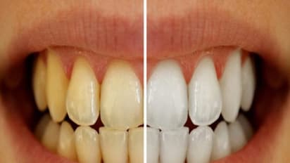 பற்களில் இருக்கும் மஞ்சள் கறையை இந்த சமையல் பொருள் விரைந்து அகற்றும்...