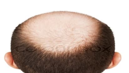 வழுக்கை தலையை சரிசெய்ய என்னவெல்லாம் செய்திருப்பீர்கள்! இதை செய்தீர்களா?