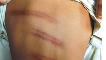 దేశానికి వాతలు పడ్డాయి