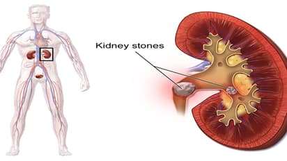 ಮೂತ್ರಪಿಂಡದ ಕಲ್ಲುಗಳ ನಿವಾರಣೆಗಾಗಿ ಮನೆಮದ್ದು