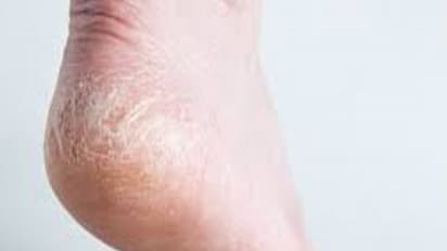 பாத வெடிப்பை விரைவில் குணமாக்க உதவும் வீட்டு மருத்துவம்... ஆண்களுக்கும் உதவும்ங்க...