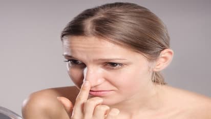 ஆண்,பெண் இருவருக்கும் முகத்தில் கரும்புள்ளிகள் வருவதற்கு இதெல்லாம்தான் காரணம்...