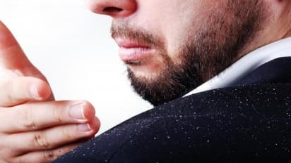 இதோ பொடுகை போக்க சில டிப்ஸ்…