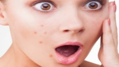 முகப்பரு ஏன் வருகிறது? அதனை போக்க சில வழிகள்…