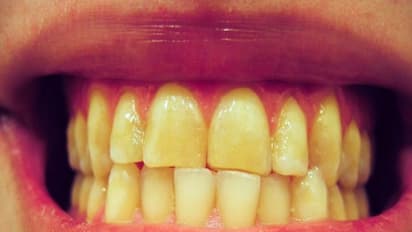 பற்களில் இருக்கும் மஞ்சள் கரையை போக்க இதைவிட சூப்பர் டிப்ஸ் கிடைக்காது...
