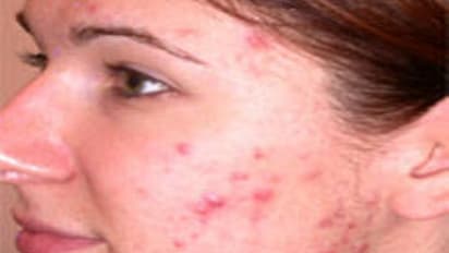 முகம் முழுவதும் பருக்கள் அதிகரிக்க இந்த ஐந்து பழக்கங்கள்தான் முக்கியமான காரணம்...