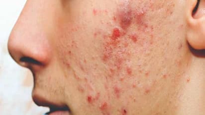 வீட்டிலேயே கிடைக்கும் இந்த பொருட்களைக் கொண்டு முகப்பருவை எளிதில் விரட்டலாம்...