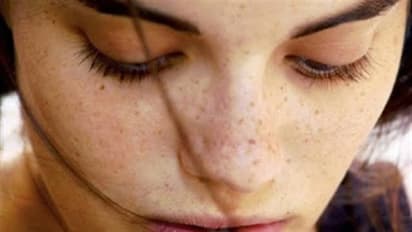 உங்களுக்குத் தெரியுமா? இந்த இரண்டு வழிகளை கொண்டு கரும்புள்ளிகளை போக்கலாம்...