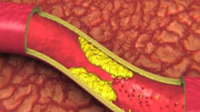 ரத்தகுழாய் அடைப்பை நீக்கும் இயற்கை பானம்; செய்முறையும் உள்ளே இருக்கு...
