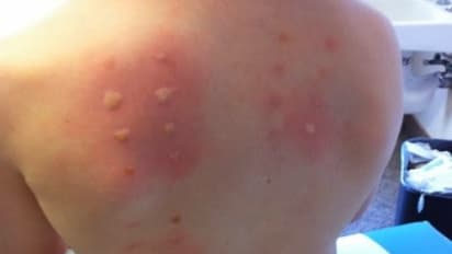 உங்களுக்குத் தெரியுமா? அலர்ஜி இருக்கானு தெரிஞ்சுக்க ஐந்து பரிசோதனைகள் இருக்கு…