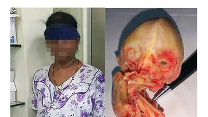 ജീവനറ്റ കുഞ്ഞിനെ പതിനഞ്ച് വര്ഷം ഉദരത്തില് ചുമന്ന് ഒരു അമ്മ