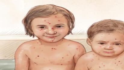 அம்மை நோயா? சாமியா? எது நிஜம் ?