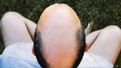 இந்த ஒரே ஒரு இயற்கை சிகிச்சை முறையை பயன்படுத்தினால் வழுக்கைத் தலையிலும் முடி வளரும்...