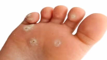 பாதங்களைத் தாக்கும் கால் ஆணியை போக்கும் சிகிச்சை இதோ…