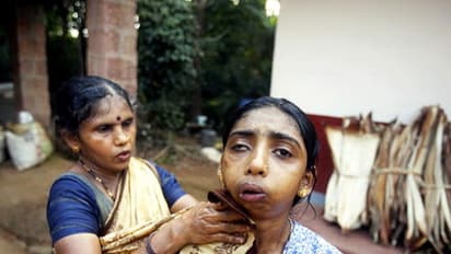 Karnataka: No relief in sight for Endosulfan victims