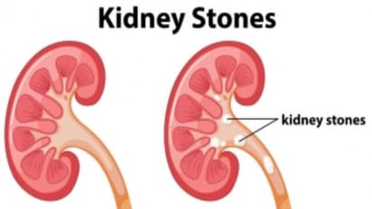 வீட்டு வைத்தியத்தின் மூலமே சிறுநீரக கல்லை குணமாக்கலாம்...எப்படி?