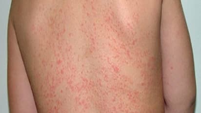 வெயில் காலத்தில் வரும் வியர்குருவால் ஒரே தொல்லையா இருக்கா? எரிச்சல் வேண்டாம்! இதோ சூப்பர் டிப்ஸ்...