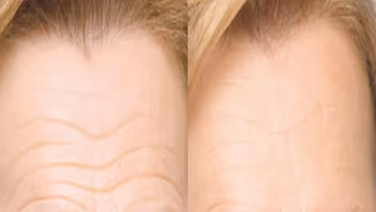 நெற்றியில் இருக்கும் சுருக்கத்தைப் போக்க இதோ அட்டகாசமான டிப்ஸ் - ஆண், பெண் இருவரும் பயன்படுத்தலாம்...