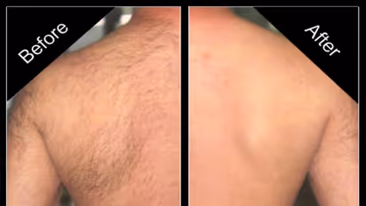 உடலில் உள்ள தேவையற்ற முடியை நீக்க...இதை தடவினாலே உதிர்ந்து விடும்..!